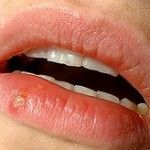 Herpes: Saiba o que é e como se proteger